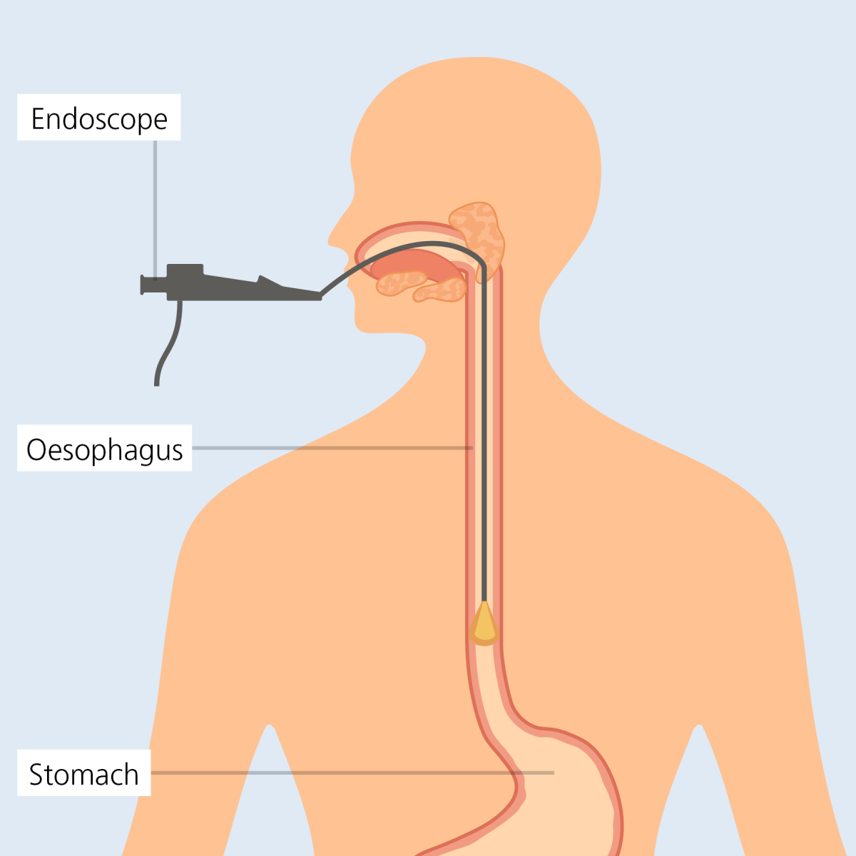 Dilation Eosinophilic Oesophagitis