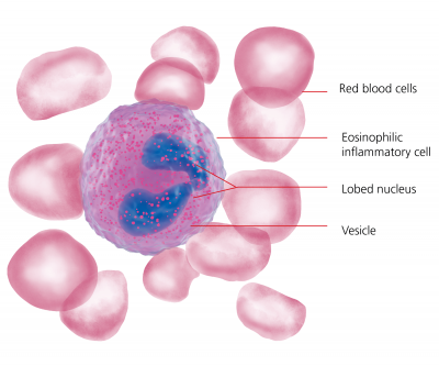 Diagnosis - Eosinophilic Oesophagitis